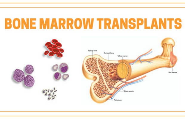 Kidney Failure