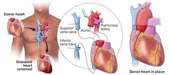 Kidney Failure