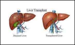 Kidney Failure