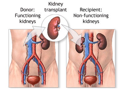Kidney Failure